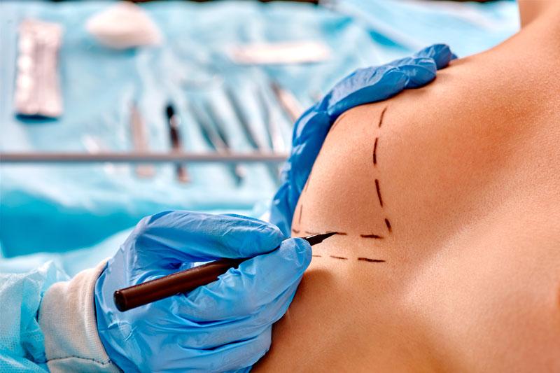 Удаление грудных имплантов