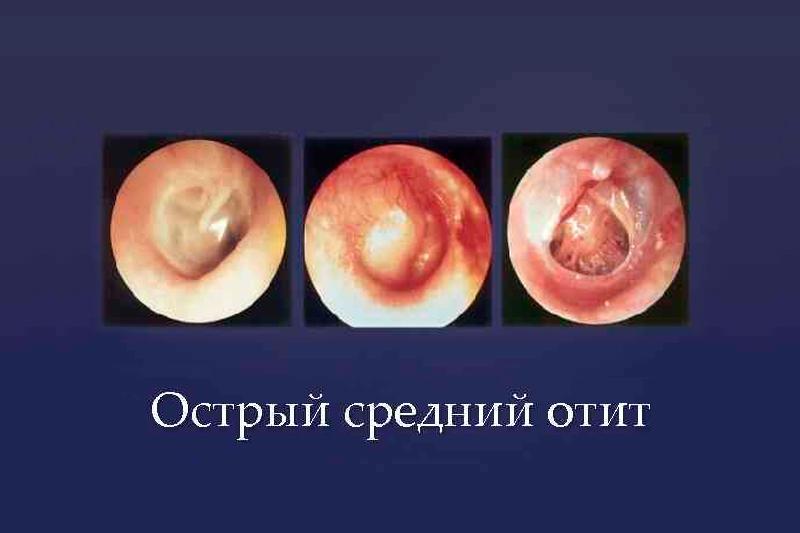 Средний отит: симптомы, диагностика и лечение отита среднего уха в СМ-Клиника в Рязани