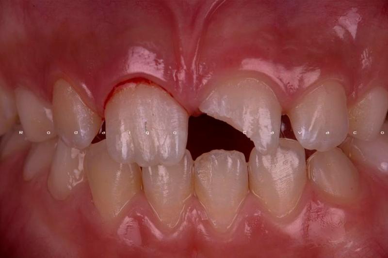 Травма зуба клиника диагностика лечение thumbnail