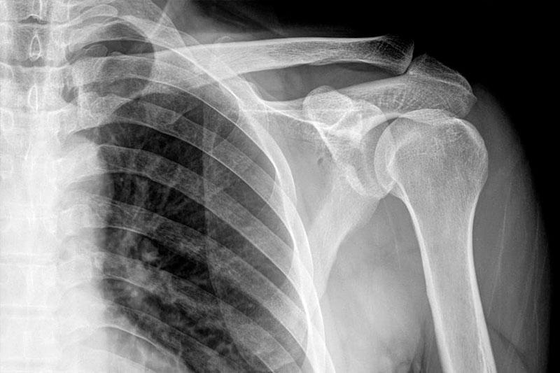 Переломы костей предплечья рентген thumbnail